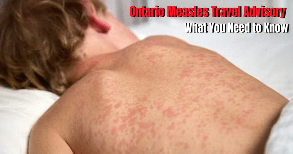 Ontario Measles Travel Advisory: What You Need to Know