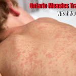 Ontario Measles Travel Advisory: What You Need to Know